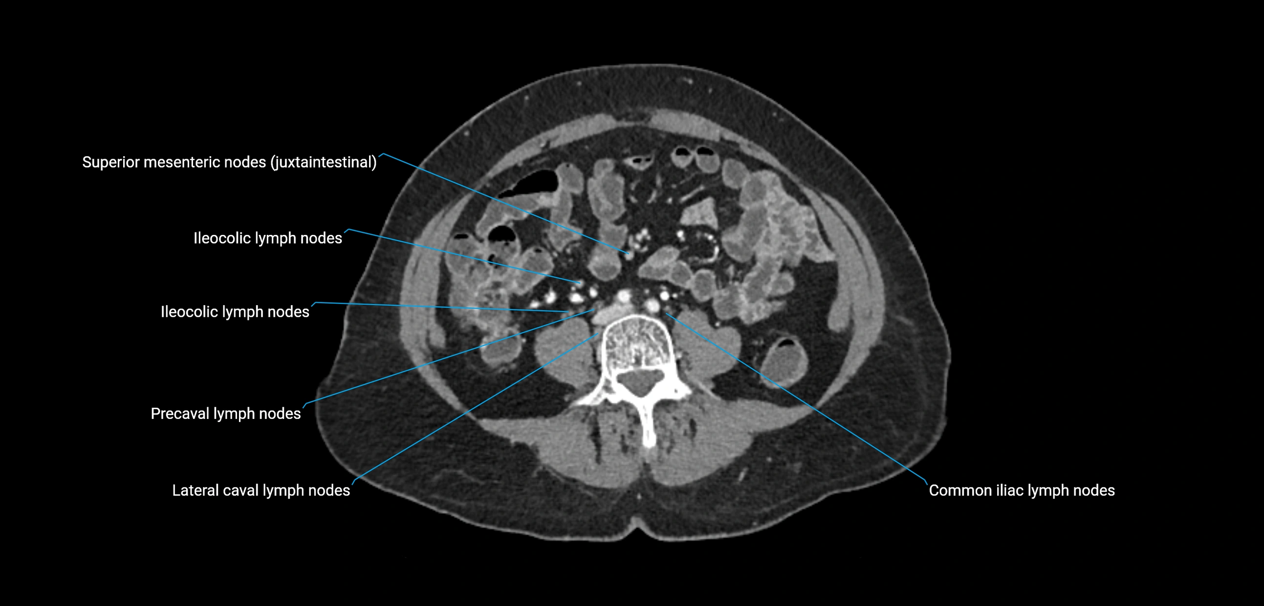 CT ct abdominal lymph nodes  axial cross sectional anatomy  enchanced radiology image -img-00002-00270.webp
